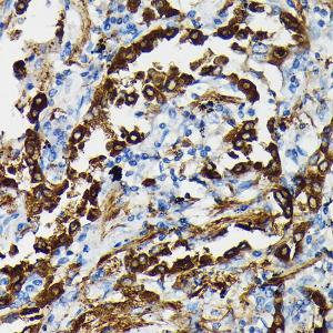 Immunohistochemistry analysis of paraffin-embedded human lung cancer using Anti-Surfactant Protein A / PSAP Antibody (A11614) at a dilution of 1:50 (40x lens). Perform high pressure antigen retrieval with 10 mM citrate buffer pH 6.0 before commencing with IHC staining protocol.