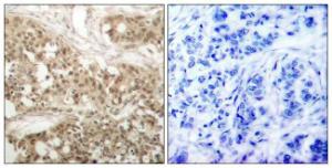 Immunohistochemical analysis of paraffin-embedded human breast carcinoma using Anti-PKC thet (phospho Ser676) Antibody. The right hand panel represents a negative control, where the antibody was pre-incubated with the immunising peptide.