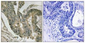 Immunohistochemical analysis of paraffin-embedded human colon carcinoma tissue using Anti-ALDOC Antibody The right hand panel represents a negative control, where the antibody was pre-incubated with the immunising peptide