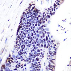 Immunohistochemistry analysis of paraffin-embedded human colon carcinoma tissue using Anti-p53 Antibody (A11620) at a dilution of 1:100 (40X lens). Perform microwave antigen retrieval with 10 mM Tris/EDTA buffer pH 9.0 before commencing with IHC staining protocol