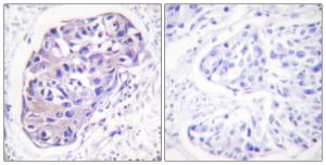 Immunohistochemical analysis of paraffin-embedded human breast carcinoma tissue using Anti-GRK2 Antibody. The right hand panel represents a negative control, where the antibody was pre-incubated with the immunising peptide