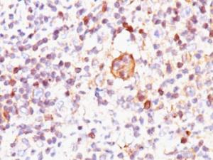 Immunohistochemical analysis of formalin-fixed, paraffin-embedded human Hodgkin's lymphoma using Anti-Bax Antibody [2D2]