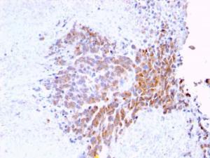 Immunohistochemical analysis of formalin-fixed, paraffin-embedded human melanoma using Anti-TOP1MT Antibody [TOP1MT/568]