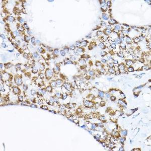 Immunohistochemistry analysis of paraffin-embedded human liver cancer using Anti-SAMM50/SAM50 Antibody (A11642) at a dilution of 1:200 (40x lens) Perform high pressure antigen retrieval with 10 mM citrate buffer pH 60 before commencing with IHC staining protocol