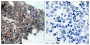 Immunohistochemical analysis of paraffin-embedded human breast carcinoma using Anti-p21 Cip1 (phospho Thr145) Antibody. The right hand panel represents a negative control, where the antibody was pre-incubated with the immunising peptide