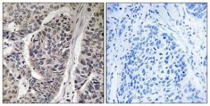 Immunohistochemical analysis of paraffin-embedded human breast carcinoma using Anti-p130 Cas (phospho Tyr410) Antibody. The right hand panel represents a negative control, where the antibody was pre-incubated with the immunising peptide