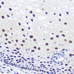 Immunohistochemistry analysis of paraffin-embedded human esophageal using Anti-JMJD1C Antibody (A306447) at a dilution of 1:100 (40X lens). Perform microwave antigen retrieval with 10 mM PBS buffer pH 7.2 before commencing with IHC staining protocol