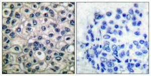 Immunohistochemical analysis of paraffin-embedded human breast cancer using Anti-p130 Cas (phospho Tyr410) Antibody 1:100 (4 °C overnight). The right hand panel represents a negative control, where the antibody was pre-incubated with the immunising peptide