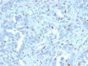 Immunohistochemical analysis of formalin-fixed, paraffin-embedded human endometrial carcinoma using Anti-Cyclin A2 Antibody [CCNA2/2333]