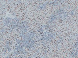 Immunohistochemical analysis of paraffin-embedded human Mesothelioma using Anti-Wilms' Tumor 1 Antibody