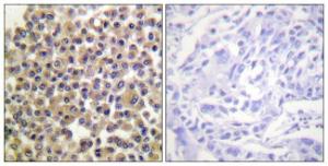 Immunohistochemical analysis of paraffin-embedded human breast carcinoma using Anti-p130 Cas (phospho Tyr249) Antibody. The right hand panel represents a negative control, where the Antibody was pre-incubated with the immunising peptide