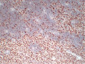 Immunohistochemical analysis of paraffin-embedded human Mesothelioma using Anti-Wilms' Tumor 1 Antibody