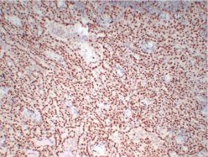 Immunohistochemical analysis of paraffin-embedded human Mesothelioma using Anti-Wilms' Tumor 1 Antibody