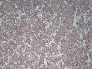 Immunohistochemical analysis of paraffin-embedded human Wilms' tumor using Anti-Wilms' Tumor 1 Antibody