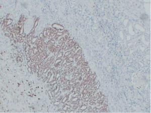 Immunohistochemical analysis of paraffin-embedded human Wilms' tumor using Anti-Wilms' Tumor 1 Antibody