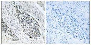 Immunohistochemical analysis of paraffin-embedded human lung cancer using Anti-ERD22 Antibody 1:100 (4°C overnight). The right hand panel represents a negative control, where the antibody was pre-incubated with the immunising peptide.