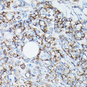 Immunohistochemistry analysis of paraffin-embedded human intestinal T-cell lymphoma using Anti-CD8 alpha Antibody [ARC0329] (A306457) at a dilution of 1:100 (40X lens). Perform high pressure antigen retrieval with 10 mM citrate buffer pH 6.0 before commencing with IHC staining protocol