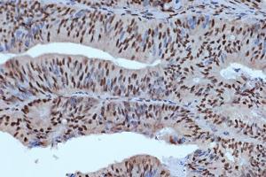 Immunohistochemistry analysis of paraffin-embedded human colon carcinoma tissue using Anti-Bub3 Antibody [ARC1318] (A307916) at a dilution of 1:100 (40x lens). Perform microwave antigen retrieval with 10 mM Tris/EDTA buffer pH 9.0 before commencing with IHC staining protocol.