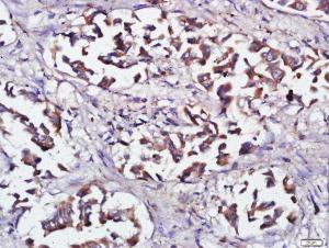 Formalin-fixed and paraffin embedded Human Lung tissue labeled with RNF138 Polyclonal Antibody (bs-9254R) at 1:200, followed by conjugation to the seconary antibody and DAB staining