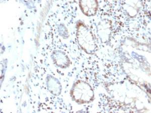 Immunohistochemical analysis of formalin-fixed, paraffin-embedded human colon carcinoma using Anti-RAD51 Antibody [RAD51/2702]