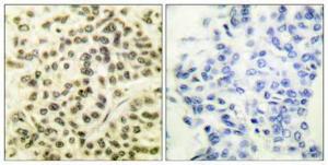 Immunohistochemical analysis of paraffin-embedded human breast cancer using Anti-MAPKAPK2 (phospho Thr334) Antibody 1:100 (4°C overnight). The right hand panel represents a negative control, where the antibody was pre-incubated with the immunising peptide.