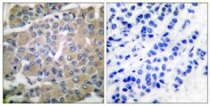 Immunohistochemical analysis of paraffin-embedded human breast carcinoma tissue using Anti-MMP-8 Antibody. The right hand panel represents a negative control, where the antibody was pre-incubated with the immunising peptide