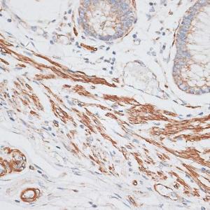 Immunohistochemistry analysis of paraffin-embedded human colon carcinoma tissue using Anti-GRK5 Antibody (A11696) at a dilution of 1:100 (40x lens). Perform microwave antigen retrieval with 10 mM PBS buffer pH 7.2 before commencing with IHC staining protocol