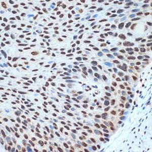 Immunohistochemistry analysis of paraffin-embedded human esophageal cancer using Anti-Histone H2B Antibody [ARC2337] (A306466) at a dilution of 1:100 (40x lens). Perform microwave antigen retrieval with 10 mM Tris/EDTA buffer pH 9.0 before commencing with IHC staining protocol.