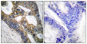 Immunohistochemical analysis of paraffin-embedded human colon carcinoma tissue using Anti-MMP-7 Antibody The right hand panel represents a negative control, where the antibody was pre-incubated with the immunising peptide