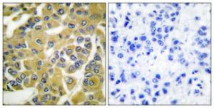 Immunohistochemical analysis of paraffin-embedded human breast carcinoma using Anti-IKK-beta (phospho Tyr188) Antibody. The right hand panel represents a negative control, where the Antibody was pre-incubated with the immunising peptide