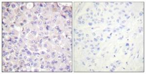 Immunohistochemical analysis of paraffin-embedded human breast cancer using Anti-IKK-beta (phospho Tyr188) Antibody 1:100 (4 °C overnight). The right hand panel represents a negative control, where the Antibody was pre-incubated with the immunising peptide