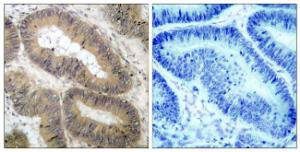 Immunohistochemical analysis of paraffin-embedded human colon carcinoma using Anti-IKK-alpha (phospho Thr23) Antibody. The right hand panel represents a negative control, where the antibody was pre-incubated with the immunising peptide