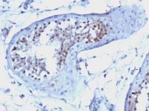 Immunohistochemical analysis of formalin-fixed, paraffin-embedded human testicular carcinoma using Anti-Cyclin B1 Antibody [CCNB1/1098]