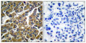 Immunohistochemical analysis of paraffin-embedded human breast carcinoma tissue using Anti-MMP-3 Antibody. The right hand panel represents a negative control, where the antibody was pre-incubated with the immunising peptide