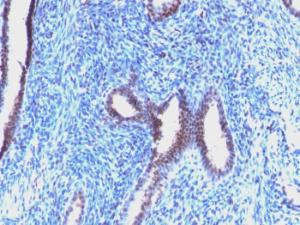 Immunohistochemical analysis of formalin-fixed, paraffin-embedded human endometrial carcinoma using Anti-Cyclin B1 Antibody [CCNB1/1098]