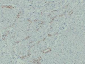 Immunohistochemical analysis of paraffin-embedded human Chromophobe cell renal carcinoma using Anti-Claudin 7 Antibody