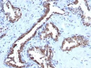 Immunohistochemical analysis of formalin-fixed, paraffin-embedded human prostate carcinoma using Anti-Cyclin B1 Antibody [CCNB1/1098]