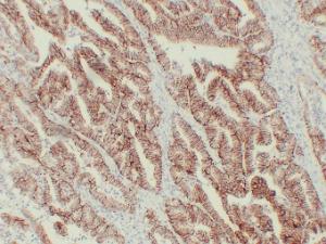 Immunohistochemical analysis of paraffin-embedded human Colon carcinoma using Anti-Claudin 7 Antibody