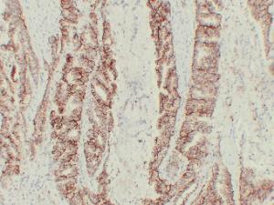 Immunohistochemical analysis of paraffin-embedded human Colon carcinoma using Anti-Claudin 7 Antibody