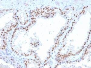 Immunohistochemical analysis of formalin-fixed, paraffin-embedded human prostate carcinoma using Anti-RET Antibody [RET/2663]