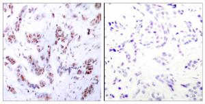 Immunohistochemical analysis of paraffin-embedded human breast carcinoma tissue using Anti-MEF2A Antibody. The right hand panel represents a negative control, where the antibody was pre-incubated with the immunising peptide.