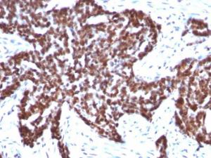 Immunohistochemical analysis of formalin-fixed, paraffin-embedded human ovarian carcinoma using Anti-Cyclin B1 Antibody [CCNB1/1098]