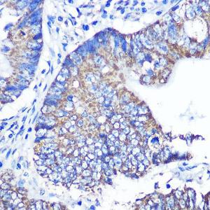 Immunohistochemistry analysis of paraffin-embedded human colon carcinoma tissue using Anti-ABCG1 Antibody (A11743) at a dilution of 1:100 (40X lens). Perform microwave antigen retrieval with 10 mM PBS buffer pH 7.2 before commencing with IHC staining protocol