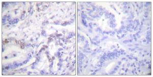 Immunohistochemical analysis of paraffin-embedded human lung carcinoma using Anti-Histone H3 (phospho Thr3) Antibody. The right hand panel represents a negative control, where the antibody was pre-incubated with the immunising peptide