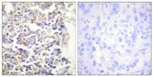 Immunohistochemical analysis of paraffin-embedded human lung carcinoma tissue using Anti-MARK3 Antibody. The right hand panel represents a negative control, where the antibody was pre-incubated with the immunising peptide