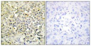 Immunohistochemical analysis of paraffin-embedded human lung carcinoma tissue using Anti-CDKL4 Antibody. The right hand panel represents a negative control, where the Antibody was pre-incubated with the immunising peptide