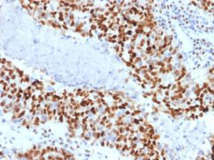 Immunohistochemical analysis of formalin-fixed, paraffin-embedded human colon carcinoma using Anti-Cyclin E Antibody [CCNE1/2460]