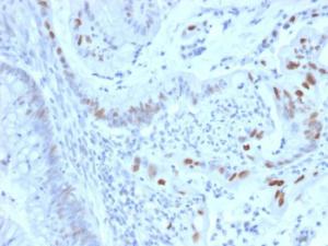 Immunohistochemical analysis of formalin-fixed, paraffin-embedded human colon carcinoma using Anti-Cyclin E Antibody [CCNE1/2460]