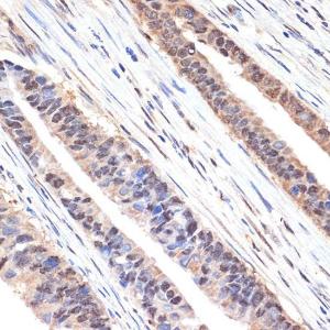 Immunohistochemistry analysis of paraffin-embedded human colon carcinoma tissue using Anti-SESN1 Antibody [ARC2313] (A306490) at a dilution of 1:100 (40X lens). Perform microwave antigen retrieval with 10 mM Tris/EDTA buffer pH 9.0 before commencing with IHC staining protocol