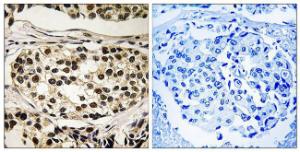 Immunohistochemical analysis of paraffin-embedded human breast carcinoma using Anti-Cyclin C (phospho Ser275) Antibody. The right hand panel represents a negative control, where the antibody was pre-incubated with the immunising peptide